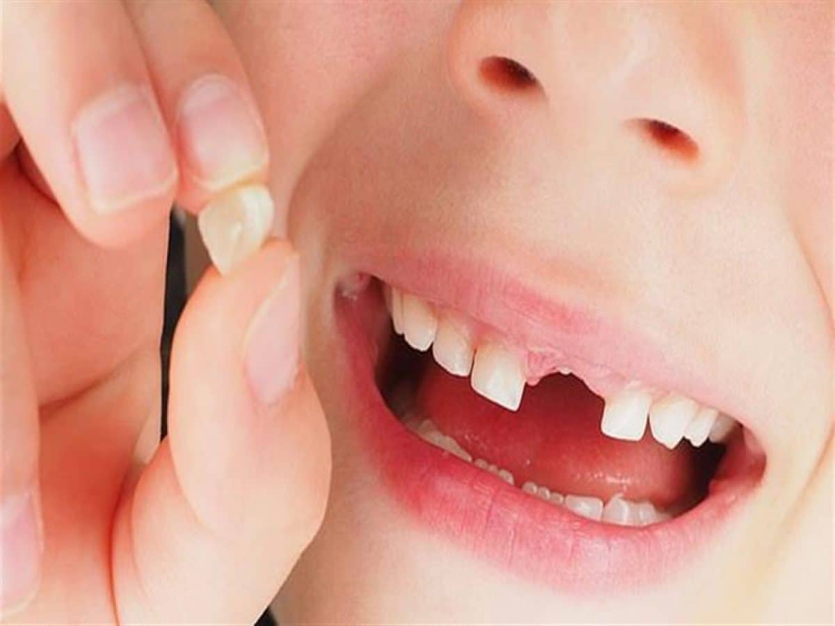 تفسير حلم سقوط الأسنان الأمامية العلوية للعزباء