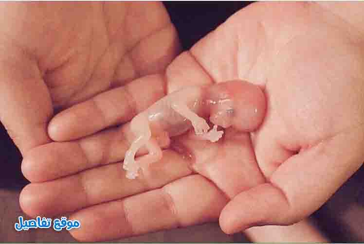 شكل إجهاض الجنين في الشهر الأول