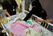 سبب وفاة أحد التوأم اليمني السيامي اليوم