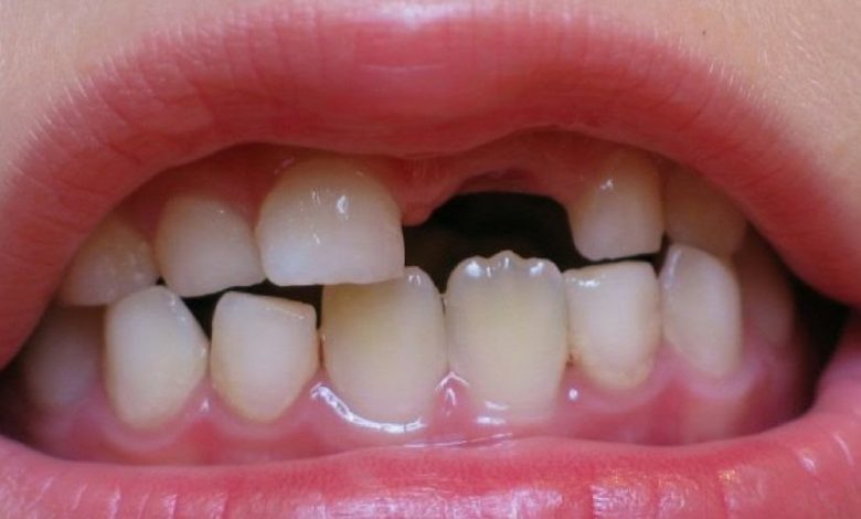 تفسير حلم سقوط الأسنان لابن سيرين بالتفصيل