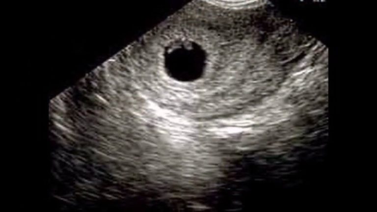 كيف اعرف ان الجنين نزل بعد الإجهاض